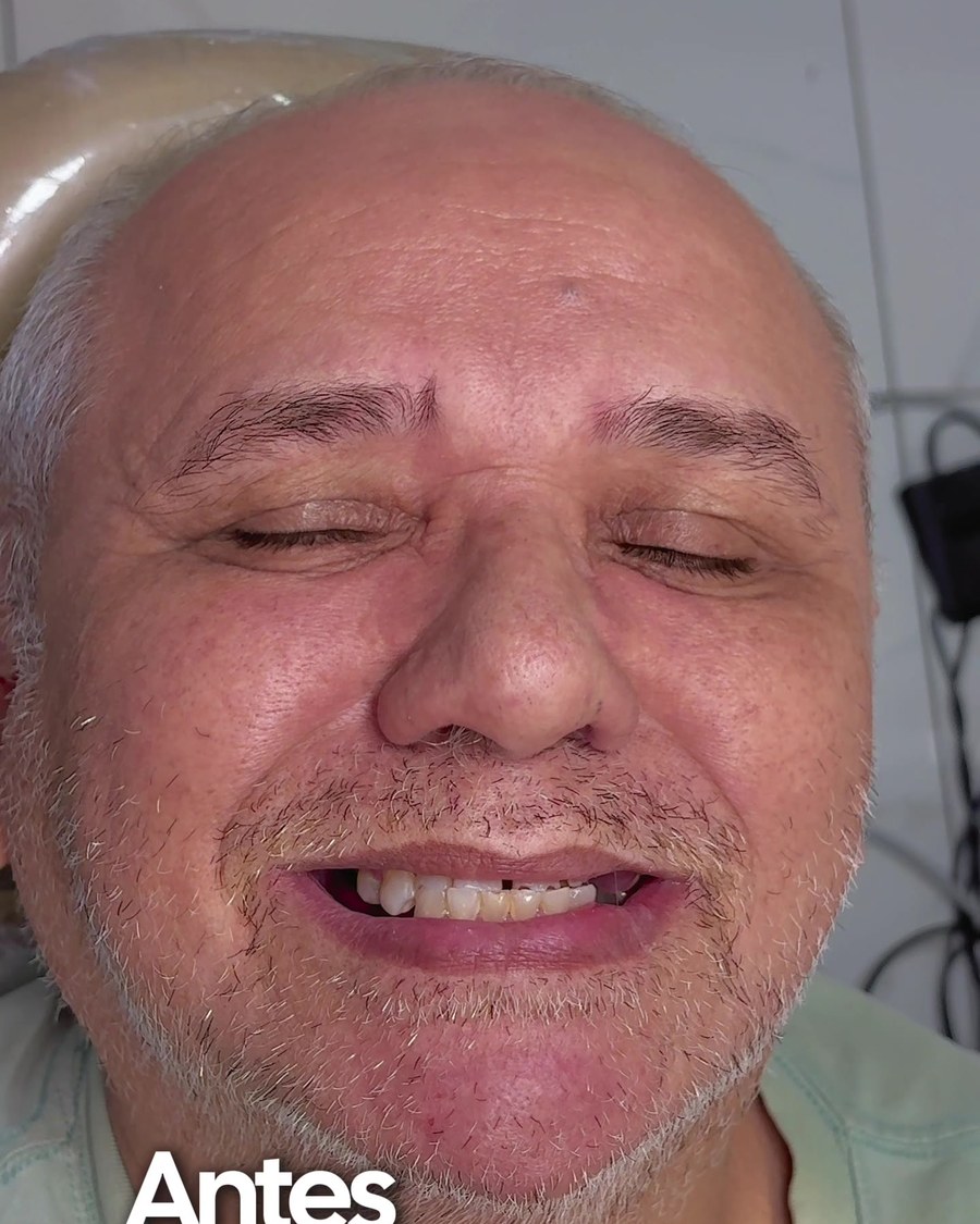 Antes - caso real de reabilitação com próteses OdontoSolutti