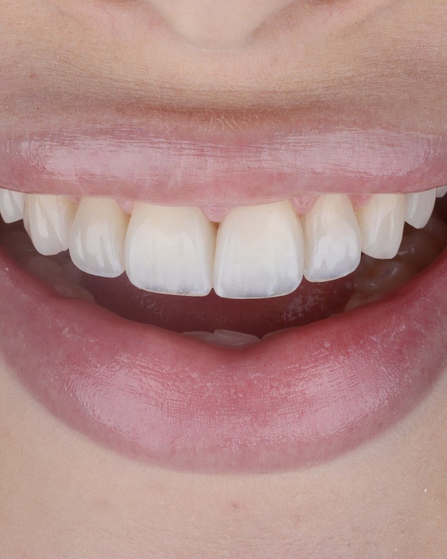 Resultado real de facetas OdontoSolutti