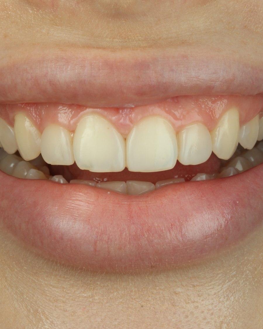 Antes - caso real de facetas OdontoSolutti