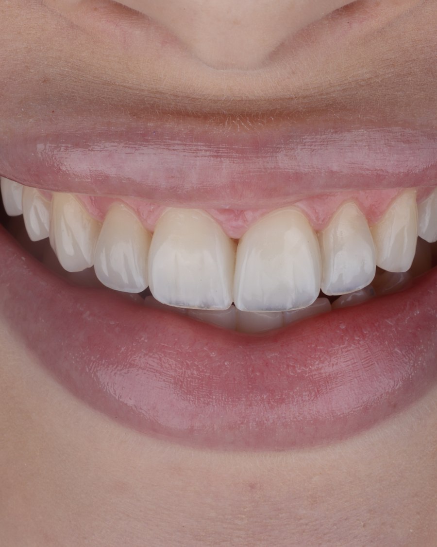 Depois - caso real de facetas OdontoSolutti
