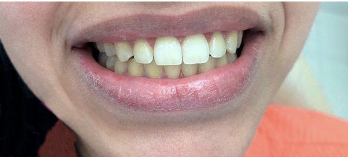 Antes - caso real de harmonização do sorriso OdontoSolutti