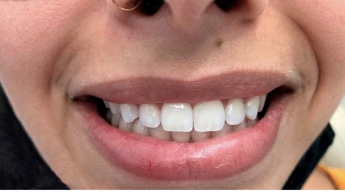 Depois - caso real de harmonização do sorriso OdontoSolutti