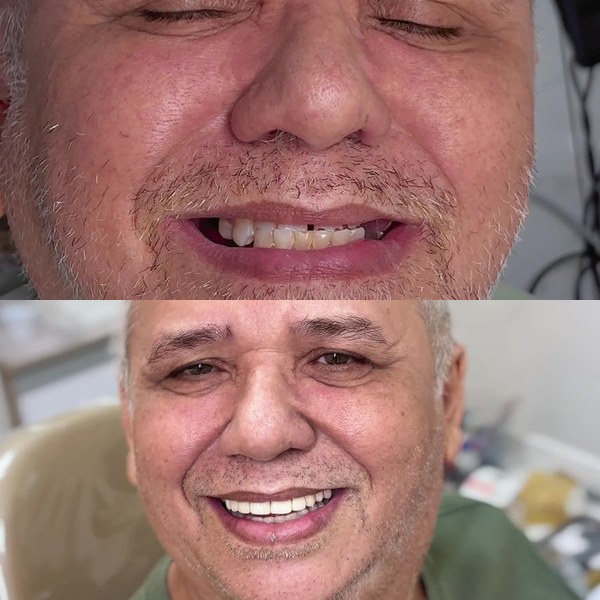 Antes e depois real de paciente OdontoSolutti