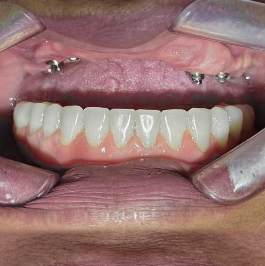 Antes - caso real de implante dentário OdontoSolutti