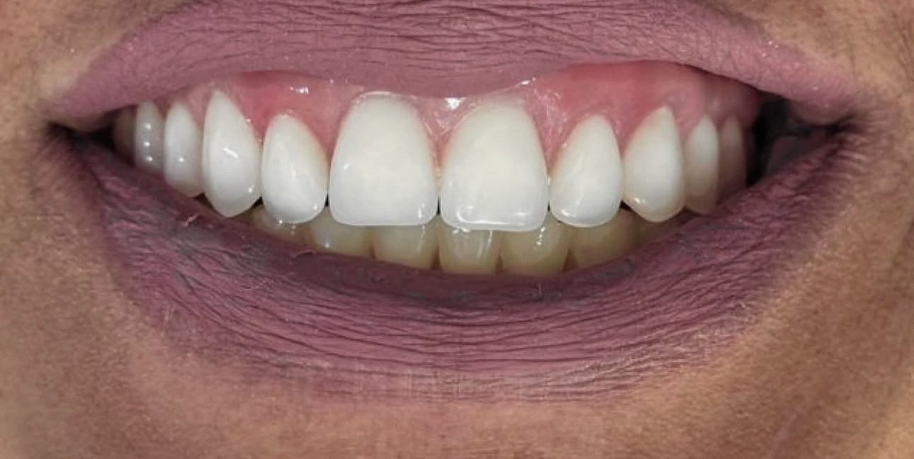 Depois - caso real de reabilitação sobre implante dentário OdontoSolutti