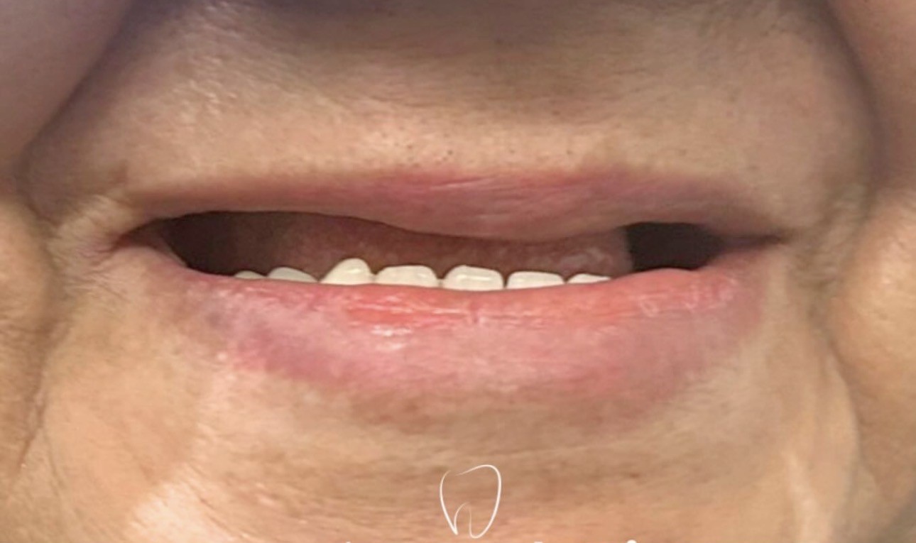 Antes - caso real de reabilitação com prótese total OdontoSolutti