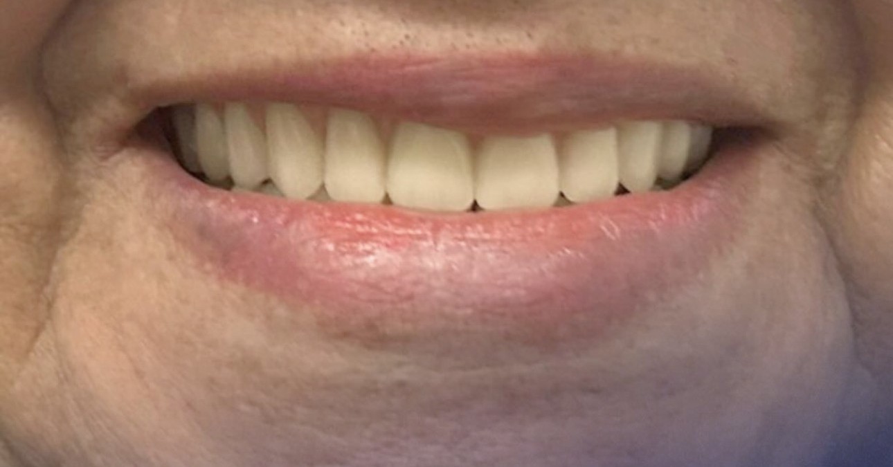 Depois - caso real de reabilitação com prótese total OdontoSolutti