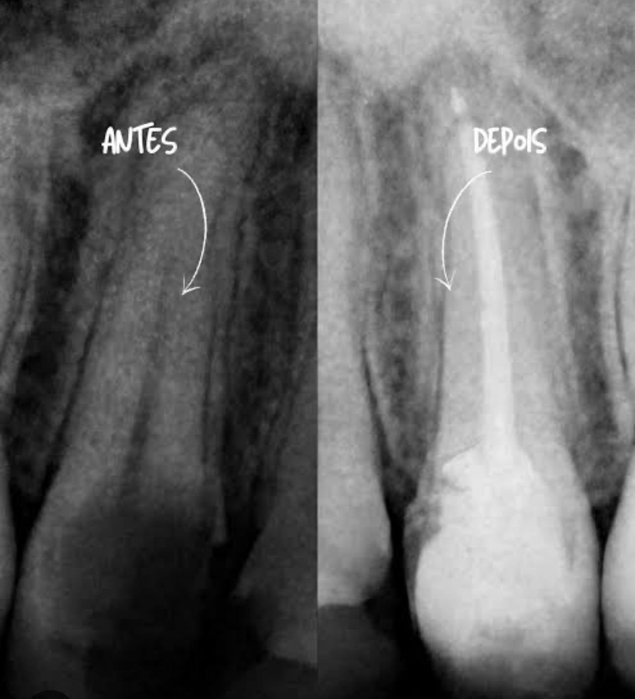 Raio-x real antes e depois de tratamento de canal OdontoSolutti