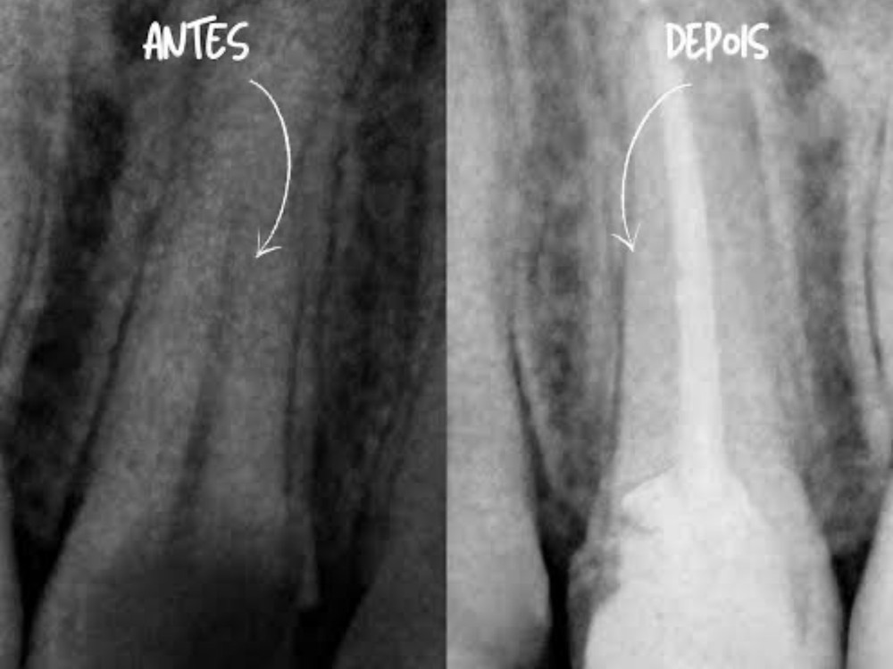 Radiografia real de tratamento de canal OdontoSolutti, antes e depois
