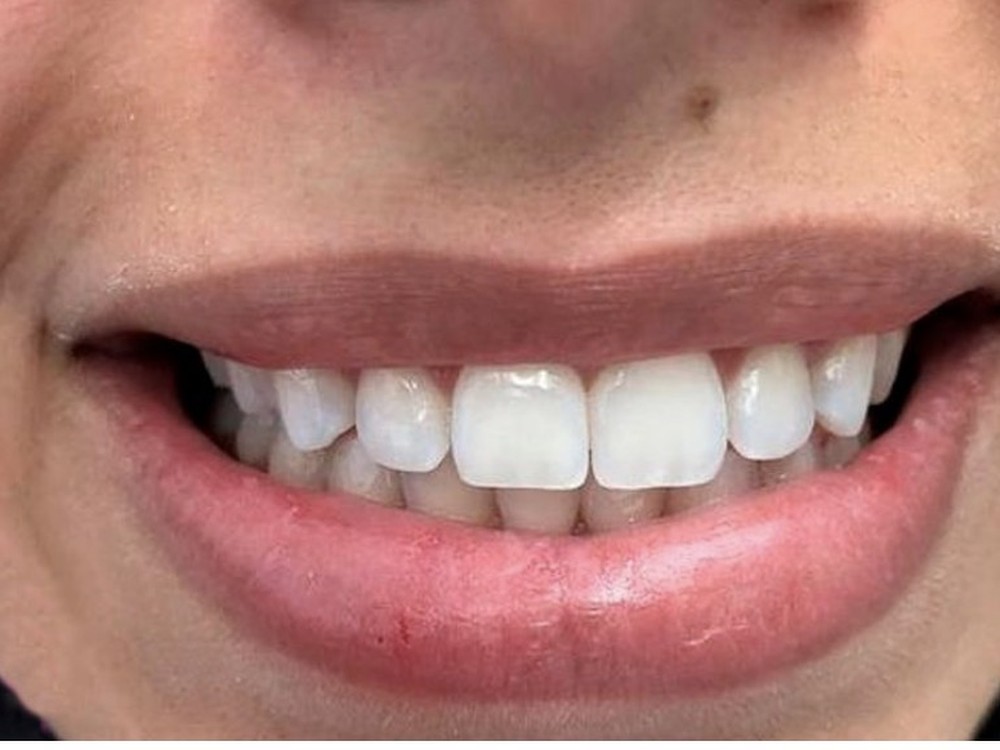 Resultado real de tratamento estético OdontoSolutti