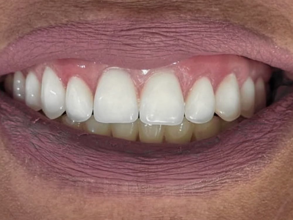 Resultado real de implante dentário OdontoSolutti