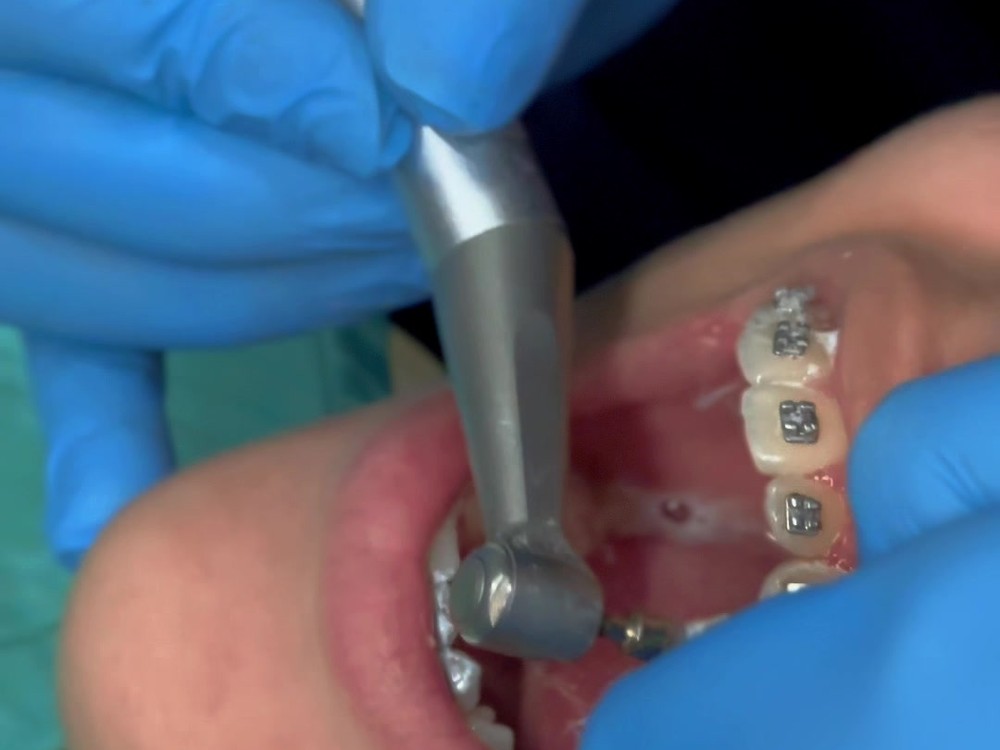 Tratamento ortodôntico real em paciente OdontoSolutti